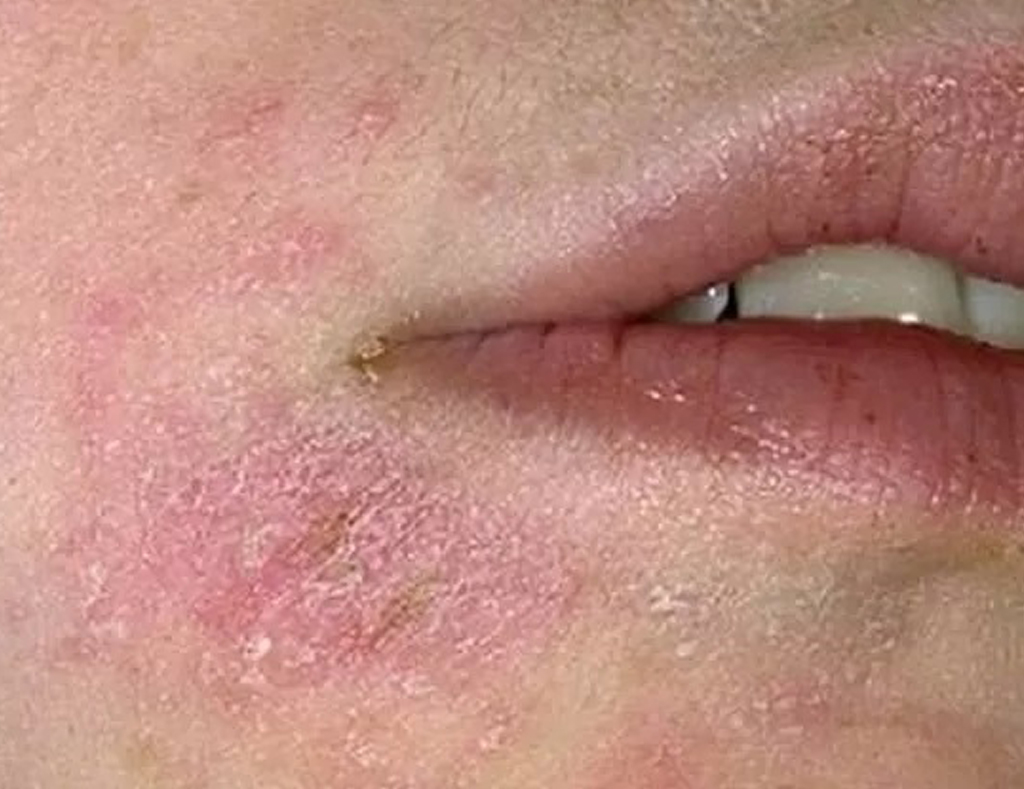 Dermatite atopica