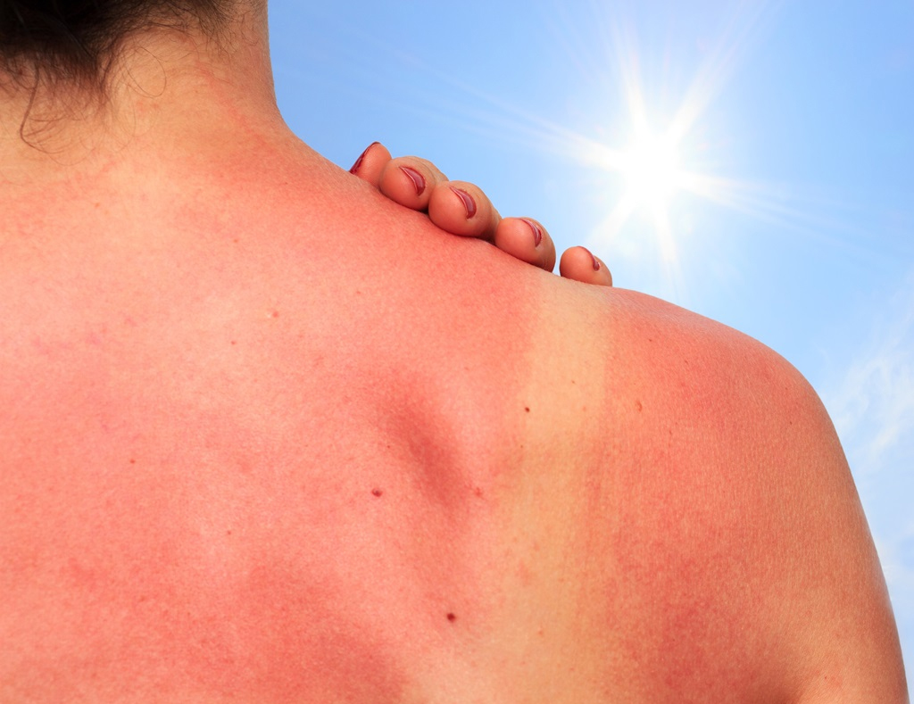 Eritema solare e vacanze