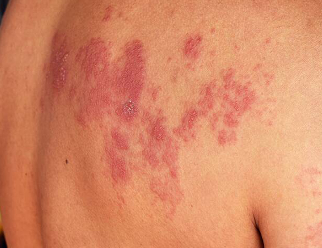 Herpes zoster