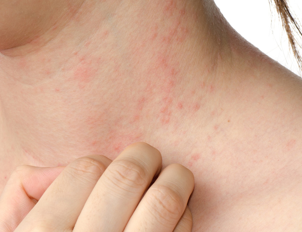 Psoriasi in estate